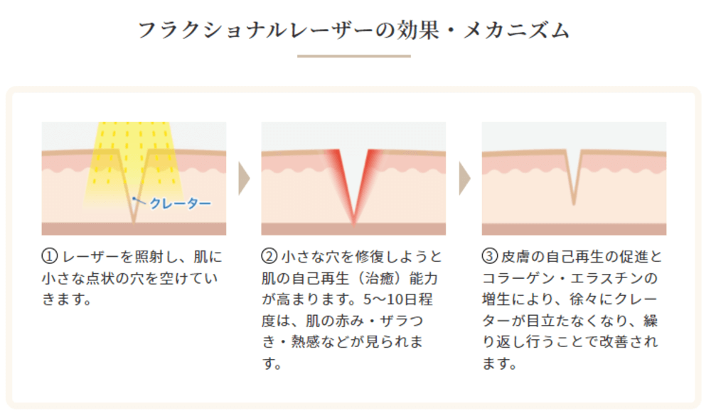 フラクショナルレーザーの効果とメカニズム