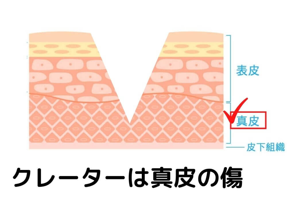 クレーター跡は真皮の傷